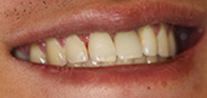 closeup of straight teeth