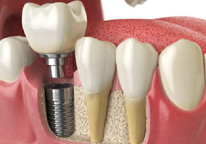 3D image of a dental implant in the lower jaw