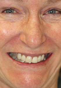 actual patient smiling after getting porcelain veneers