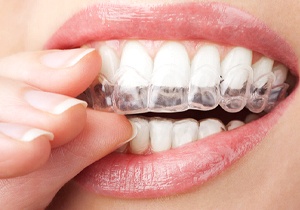 Woman putting in her teeth whitening tray