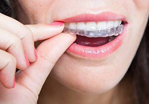 woman wearing Invisalign clear braces