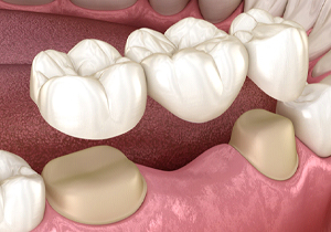 Digital image of a 3-unit dental bridge for the lower teeth 
