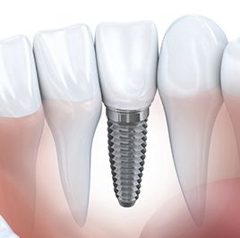 dental implants for missing teeth