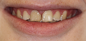 tooth #1 actual patient before porcelain veneers
