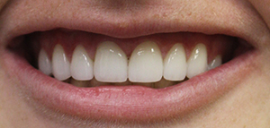 tooth #1 actual patient after porcelain veneers