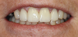tooth #2 actual patient after porcelain veneers