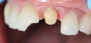 tooth #2 actual patient before porcelain veneers