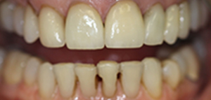 tooth #3 actual patient before porcelain veneers
