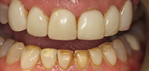 tooth #4 actual patient before porcelain veneers