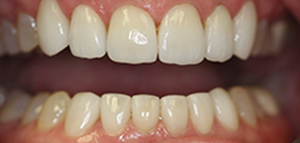 tooth #4 actual patient after porcelain veneers