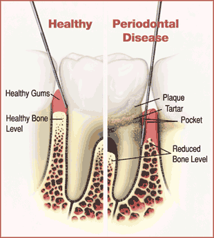 periodontal-pepperell