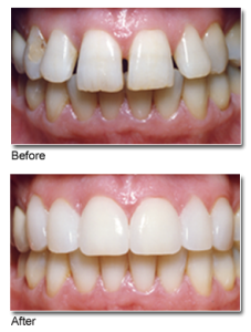 porcelain-veneers