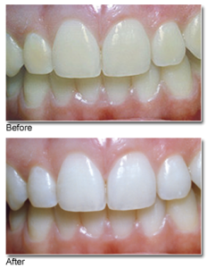 teeth-whitening