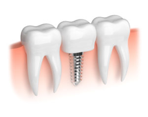 An image of a dental implant. 