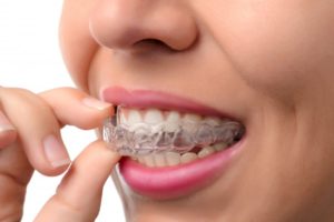 Invisalign in Reston can help you achieve optimum oral health.